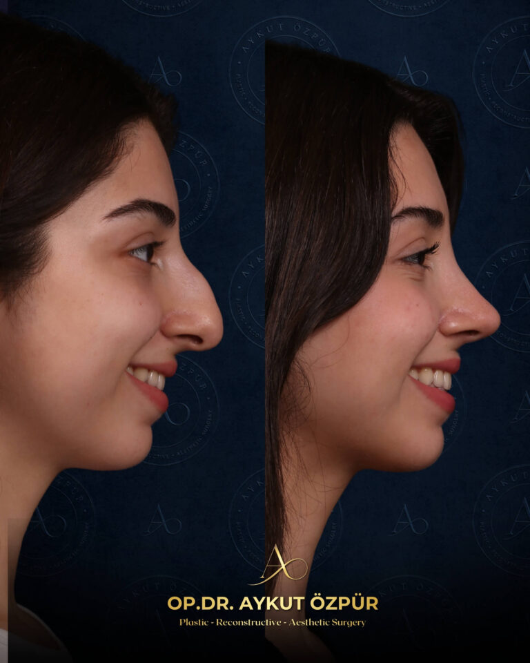 Rhinoplasty 19 11