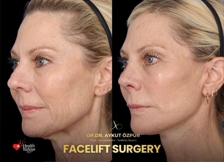 Facelift & Necklif in Turkey 21 13