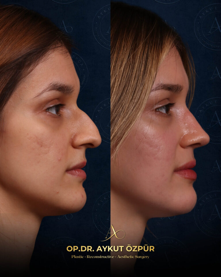 Rhinoplasty 20 17