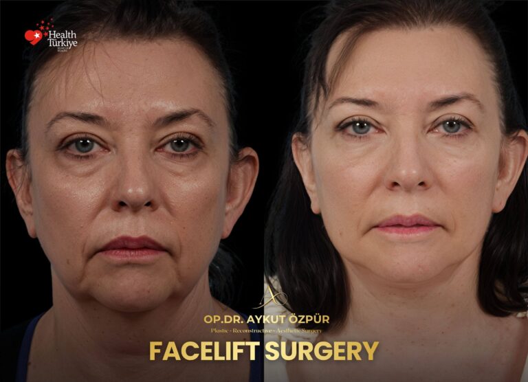 Facelift & Necklif in Turkey 23 18 2
