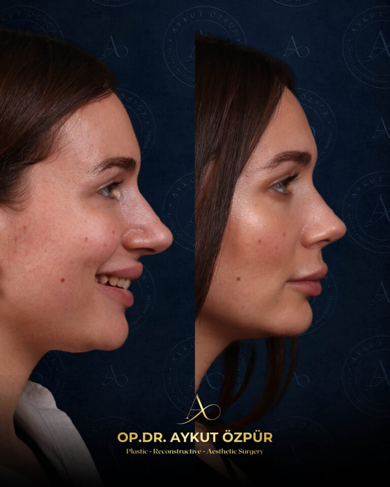Rhinoplasty 21 18