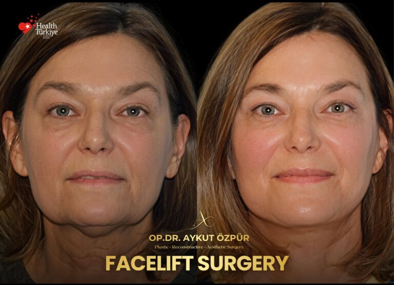 Facelift & Necklif in Turkey 22 19