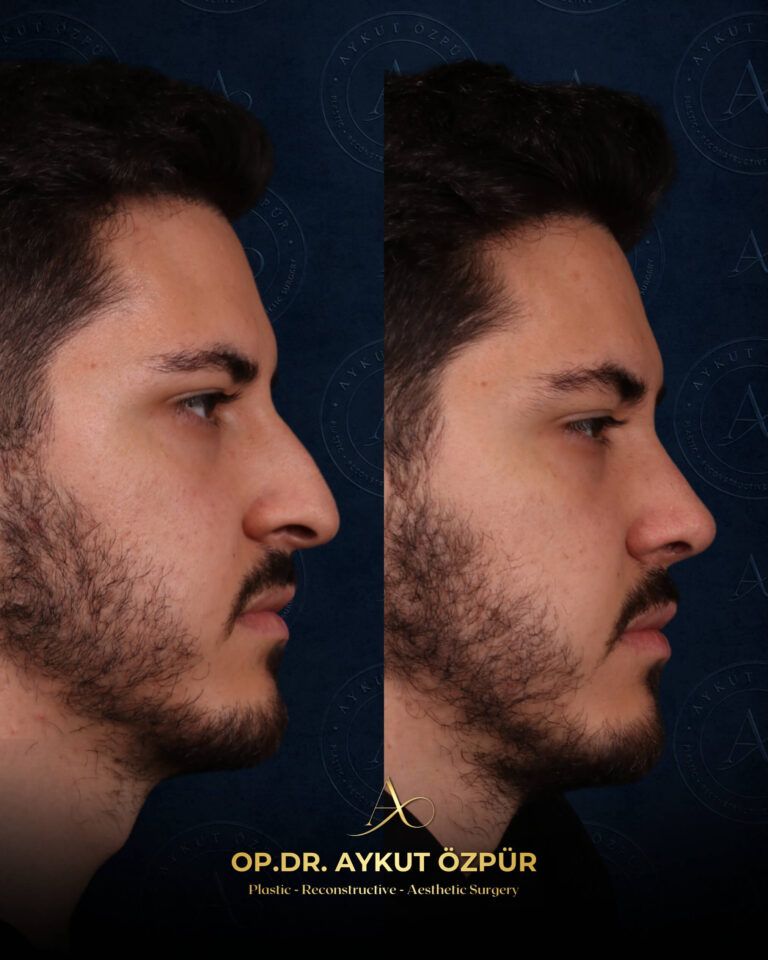 Rhinoplasty 22 26