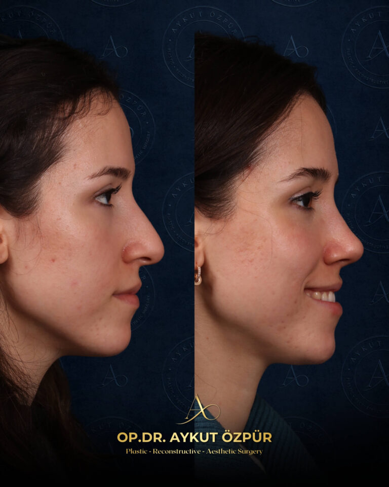 Rhinoplasty 23 32