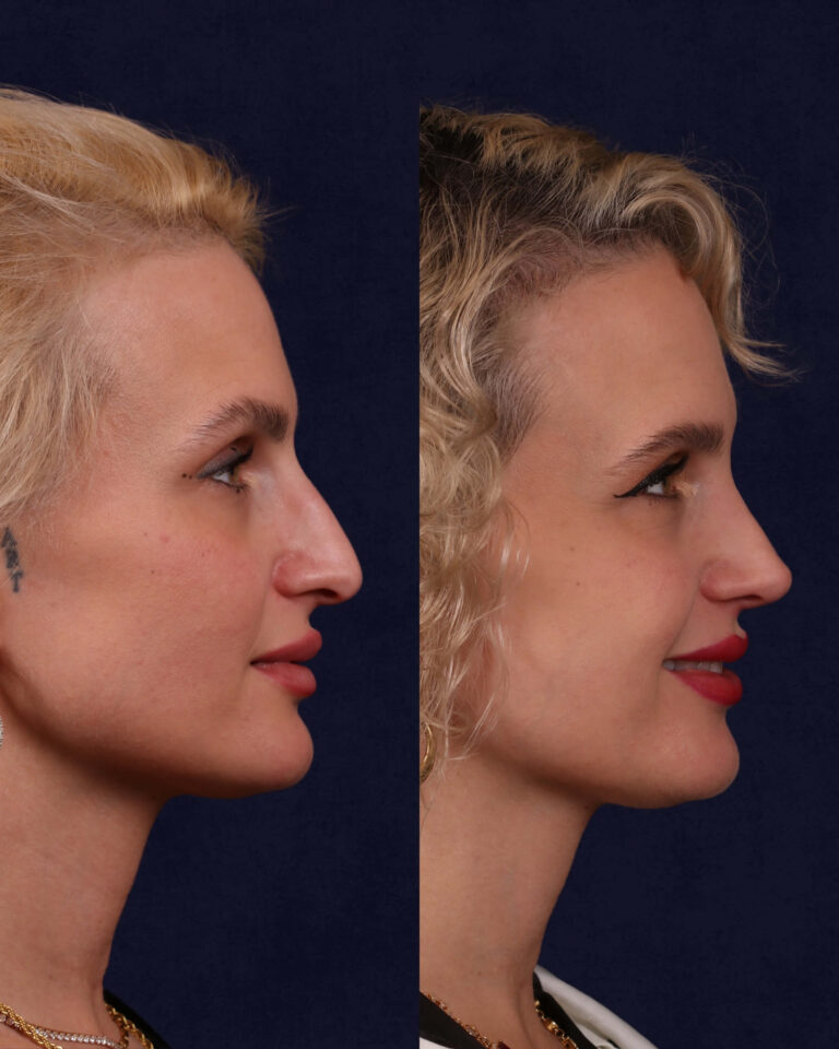 Rhinoplasty 18 4 1