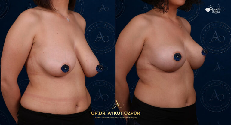 Breast Aesthetics in Turkey 21 4