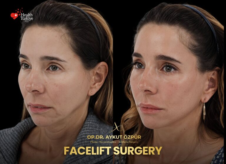 Facelift & Necklif in Turkey 18 5 2