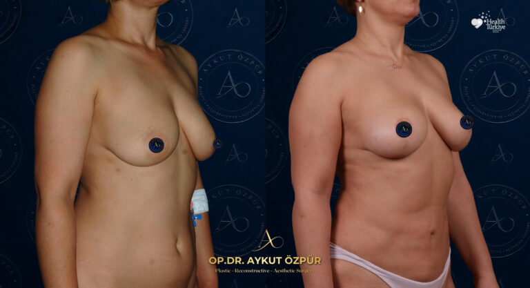 Breast Aesthetics in Turkey 22 5
