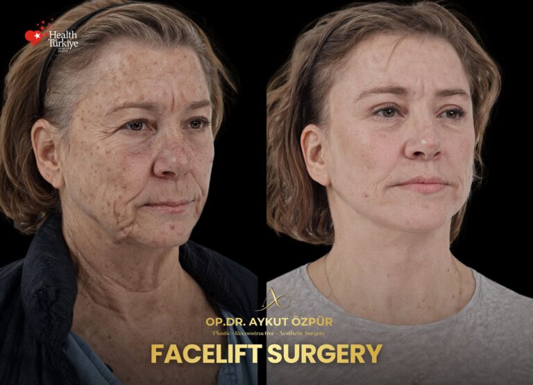Facelift & Necklif in Turkey 19 6 1