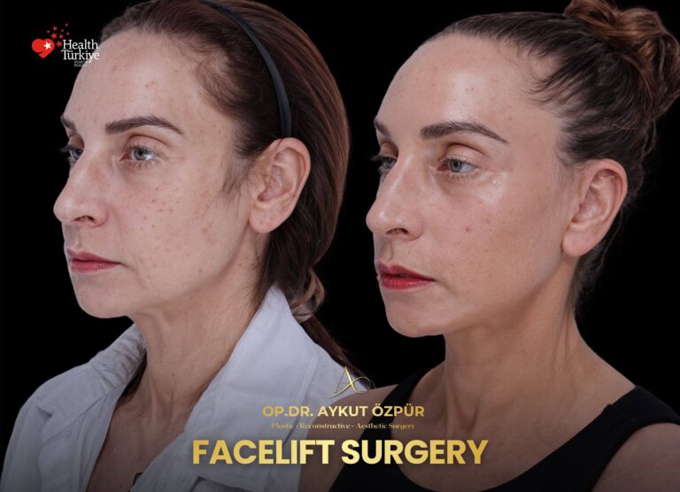 Facelift & Necklif in Turkey 20 8